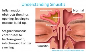 Sinusitis Surgery