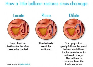 balloon restore drainage web maxillary